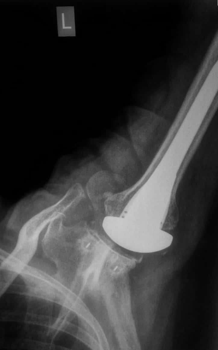 shoulder replacement surgeon in ahmedabad