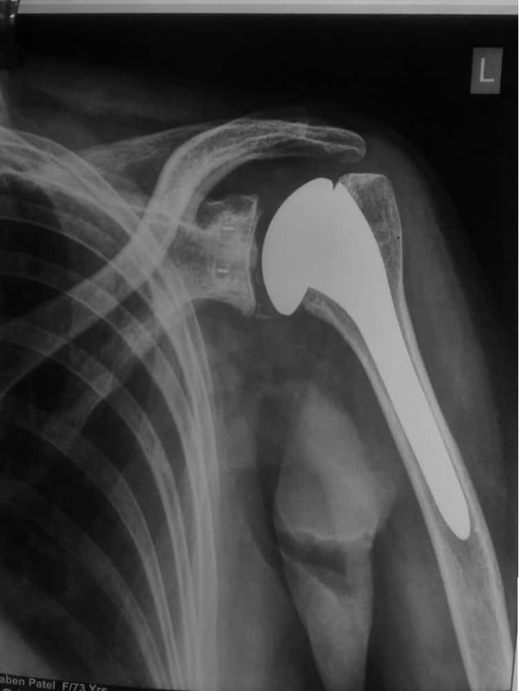 shoulder replacement surgeon in paldi